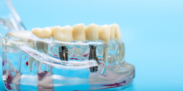 Dental implants