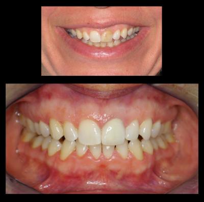 Porcelain Bonded to Metal Crown | Stanhope Place Dental Practice W2