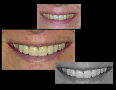 Dental veneers | Stanhope Place Dental Practice London W2