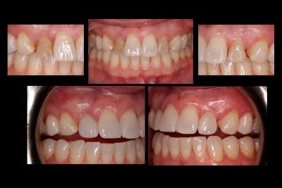 Porcelain veneers | Stanhope Place Dental Practice Lodnon W2