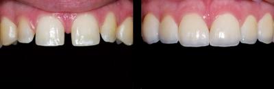 Porcelain veneers | Stanhope Place Dental Practice Lodnon W2