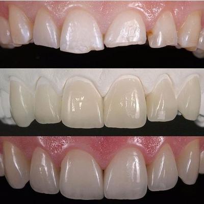 Porcelain veneers | Stanhope Place Dental Practice London W2