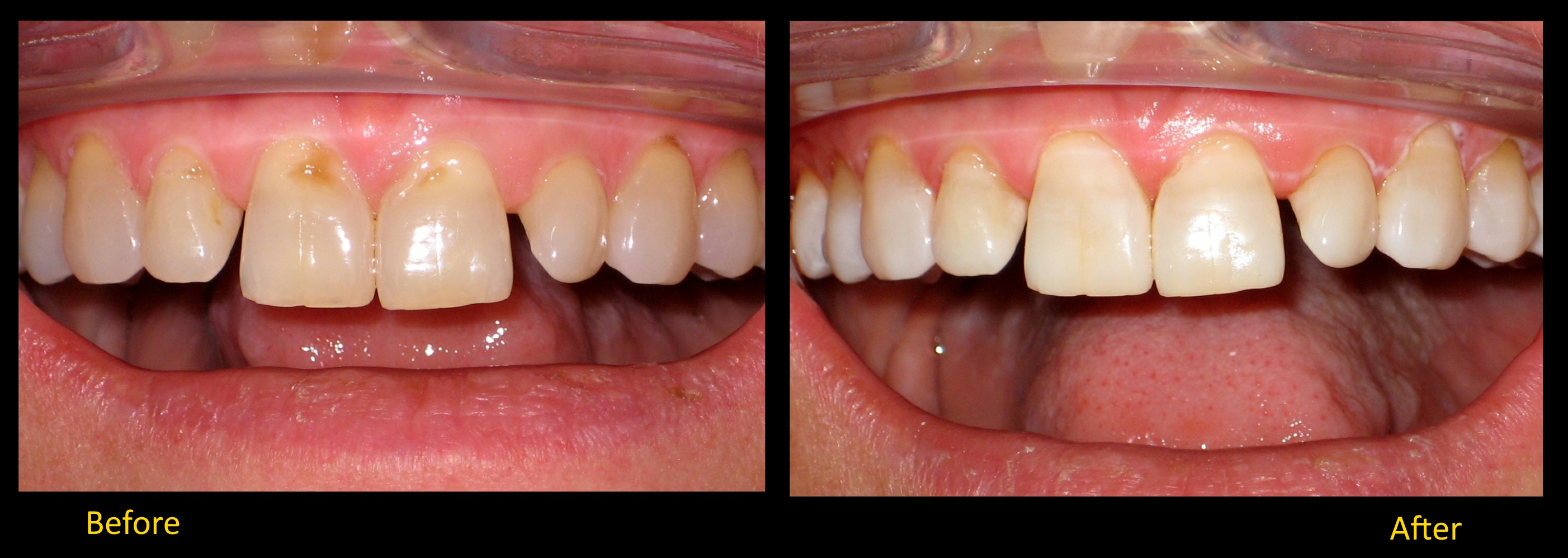 Composite bonding | Stanhope Place Dental Practice London W2