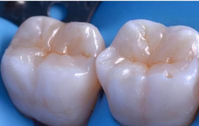 Dental fillings | Stanhope Place Dental Practice W2
