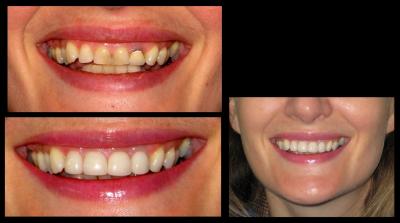 Dental crowns | Stanhope Place Dental Practice London W2
